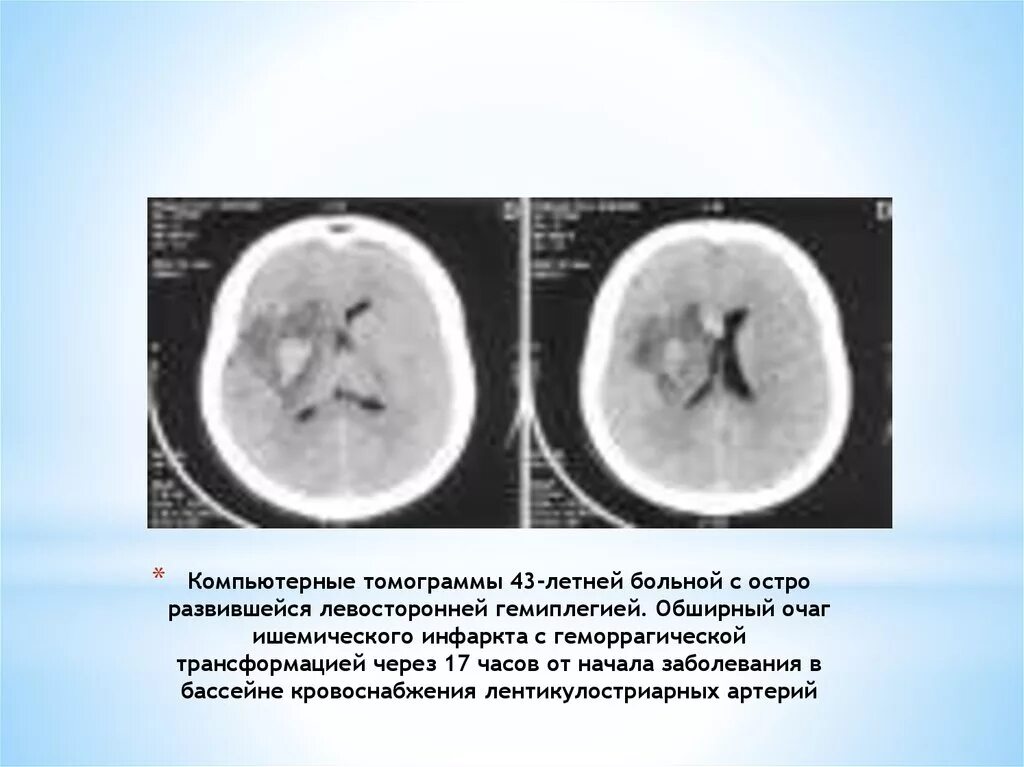 Размер ишемического очага. Очаг ишемии. Геморрагическая трансформация ишемического очага кт. Инфаркт с геморрагической трансформацией. Очаги ишемии головного мозга