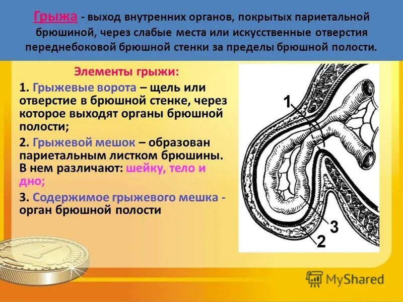 места выхода грыж