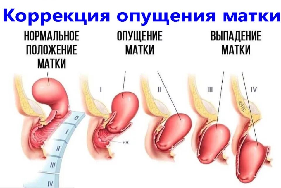 Опущение и выпадение матки. Опущение и пролапс матки. Операция опущение матки лечение