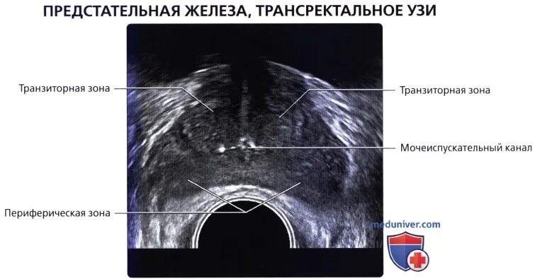 Капсула предстательной железы. Зоны предстательной железы на УЗИ. Изранов УЗИ анатомия предстательной железы. Предстательная железа анатомия зоны УЗИ. Зональная анатомия предстательной железы УЗИ.