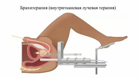 Брахитерапия шейки матки