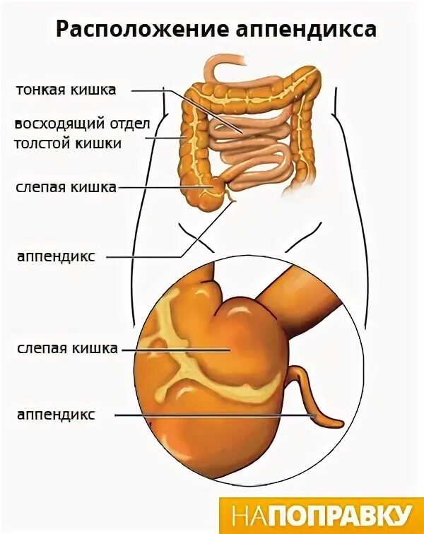 Расположение аппендикса. Где находится аппендикс. Аппендикс где находится и как болит