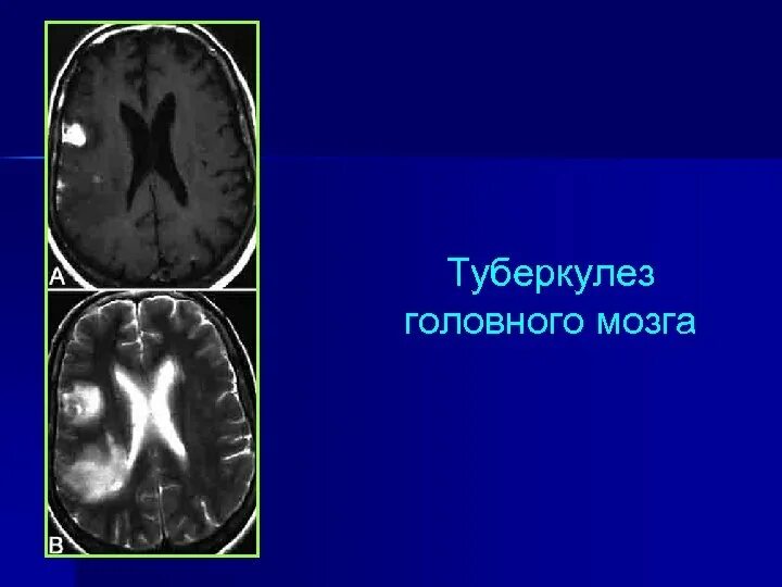 Туберкулома головного мозга кт. Туберкулема головного мозга мрт. Туберкулема головного мозга на кт. Туберкулез мозговых оболочек кт.