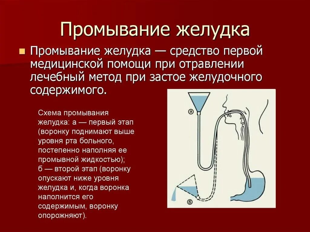 Промывание желудка. Промывание желудка при отравлении. Промывание желудка следует проводить до:. Промыть желудок при отравлении. Прочистить желудок в домашних