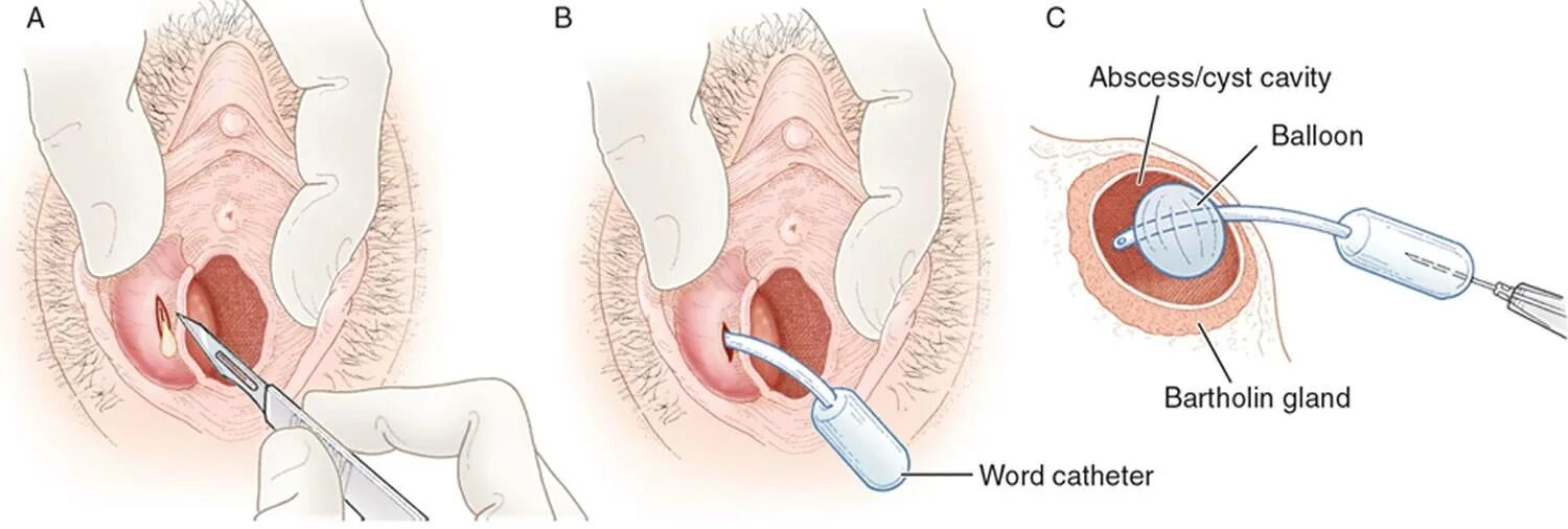 Катетер бартолиновой железы. Бартолиновая железа киста. Word катетер бартолиновой железы. Бартолиновая железа воспаление. Вылущивание кисты бартолиновой железы.