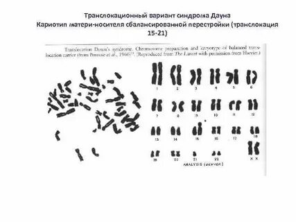 Кариотип транслокации