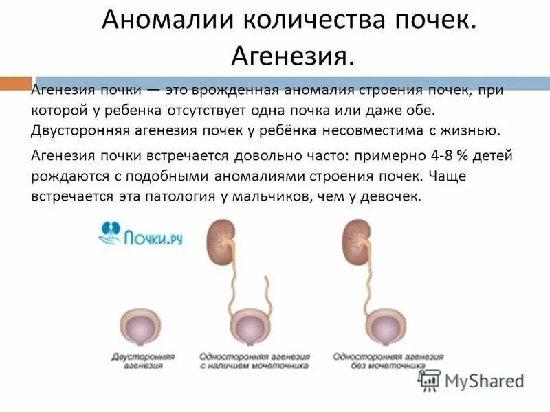 Аномалии развития почек. Аномалии строения почек. Аномалии расположения почек классификация. Аномалии и пороки развития почек у детей. Аномалии строения почек.