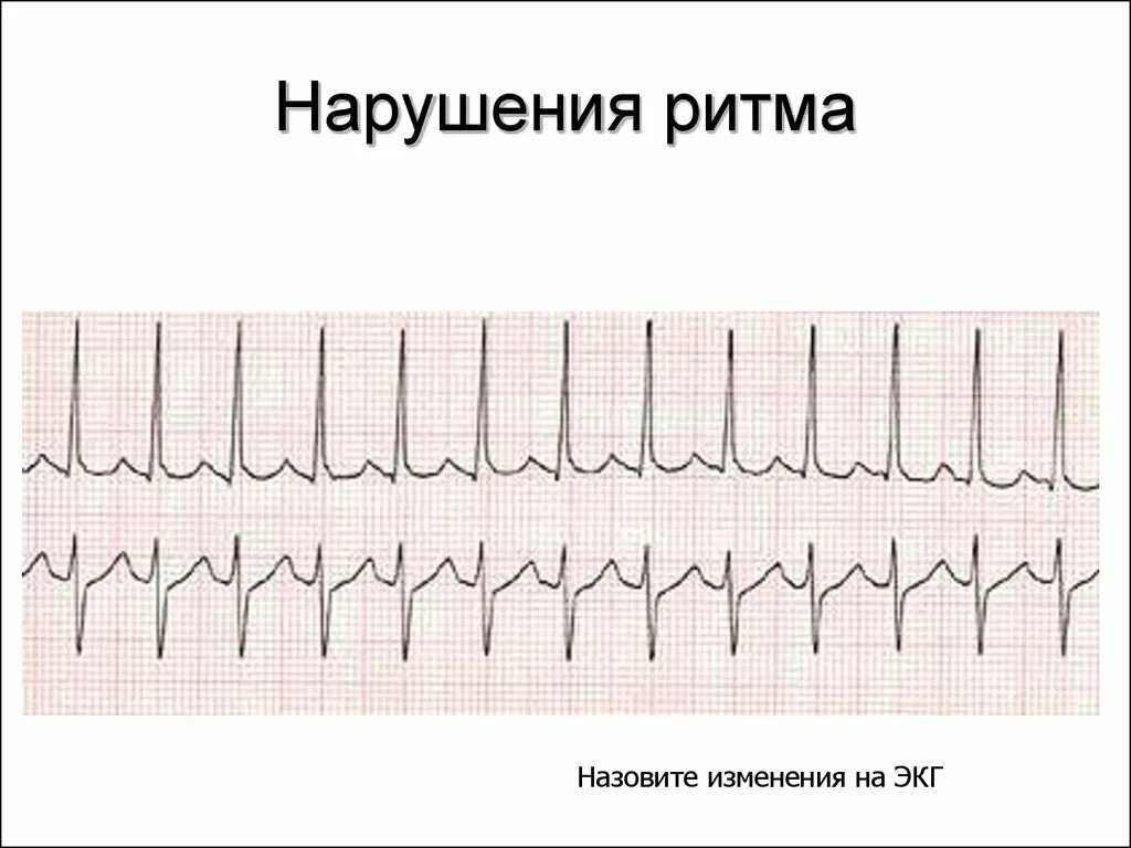 Нарушения ритма сердца тесты с ответами