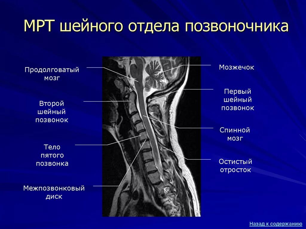 Входит в шейный отдел. Мрт шейного отдела позвоночника и спинного мозга. мрт анатомия шейного отдела позвоночника. мрт шейного отдела норма. мрт шейного отдела позвоночника норма.
