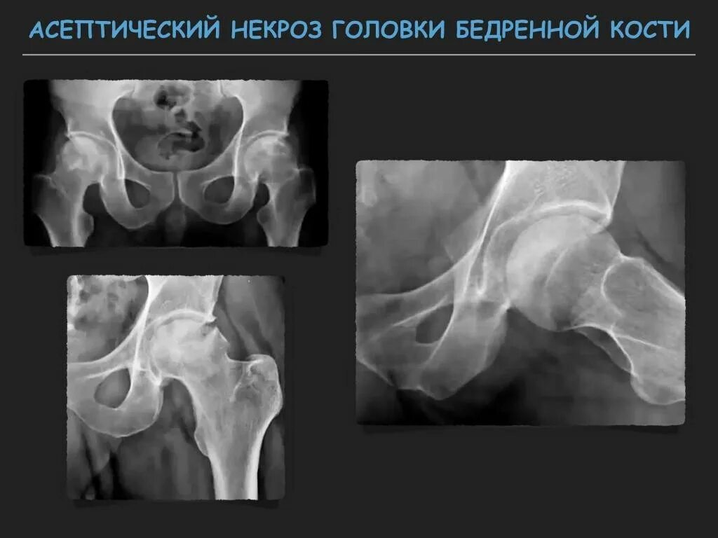 Асептический некроз без операции. Асептический некроз головки бедренной кости рентген. Некроз кости тазобедренного сустава. Асептический некроз тазобедренного сустава кт. Рентген асептический некроз бедренной кости.