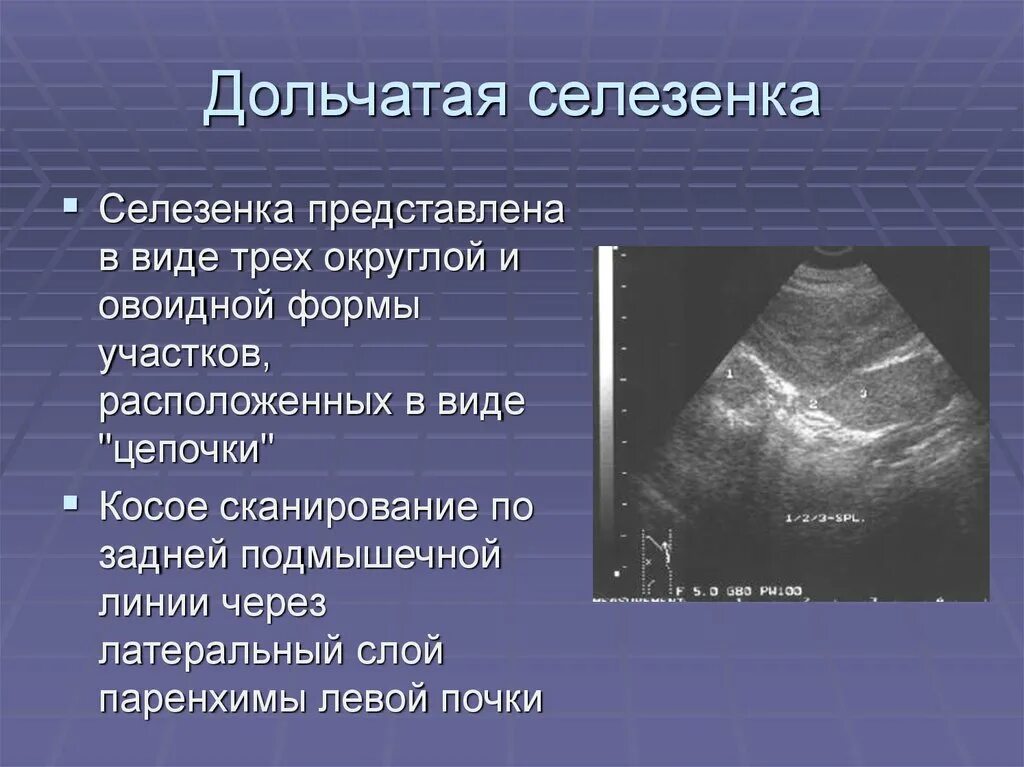 Селезенка описание. Дополнительная долька селезенки на УЗИ. Дольчатая селезенка на УЗИ. Анатомия селезенки на УЗИ.