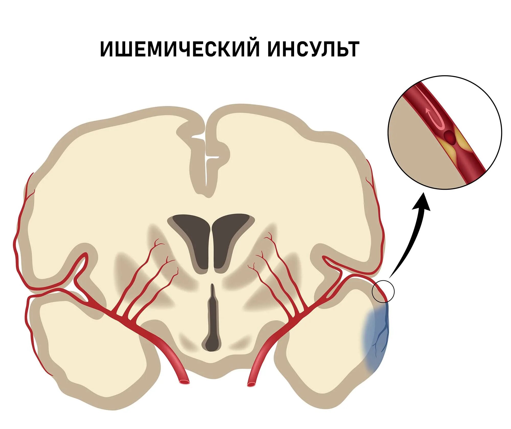 Ишемические зоны. Клиническая картина ишемического инсульта неврология. Ишемические зоны. Ишемические зоны. Ишемический инсульт при ишемической болезни сердца.