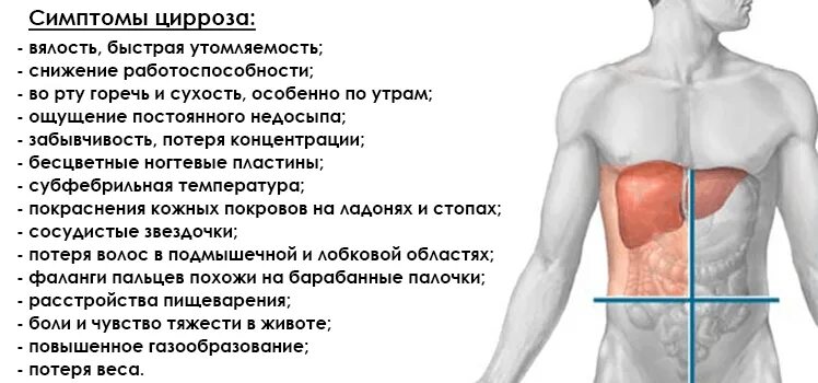 Симптомы печени как проявляется. Характерные признаки цирроза печени. 1 Признаки цирроза печени. Симптомы болезни при циррозе печени. Цирроз печени ранние симптомы.