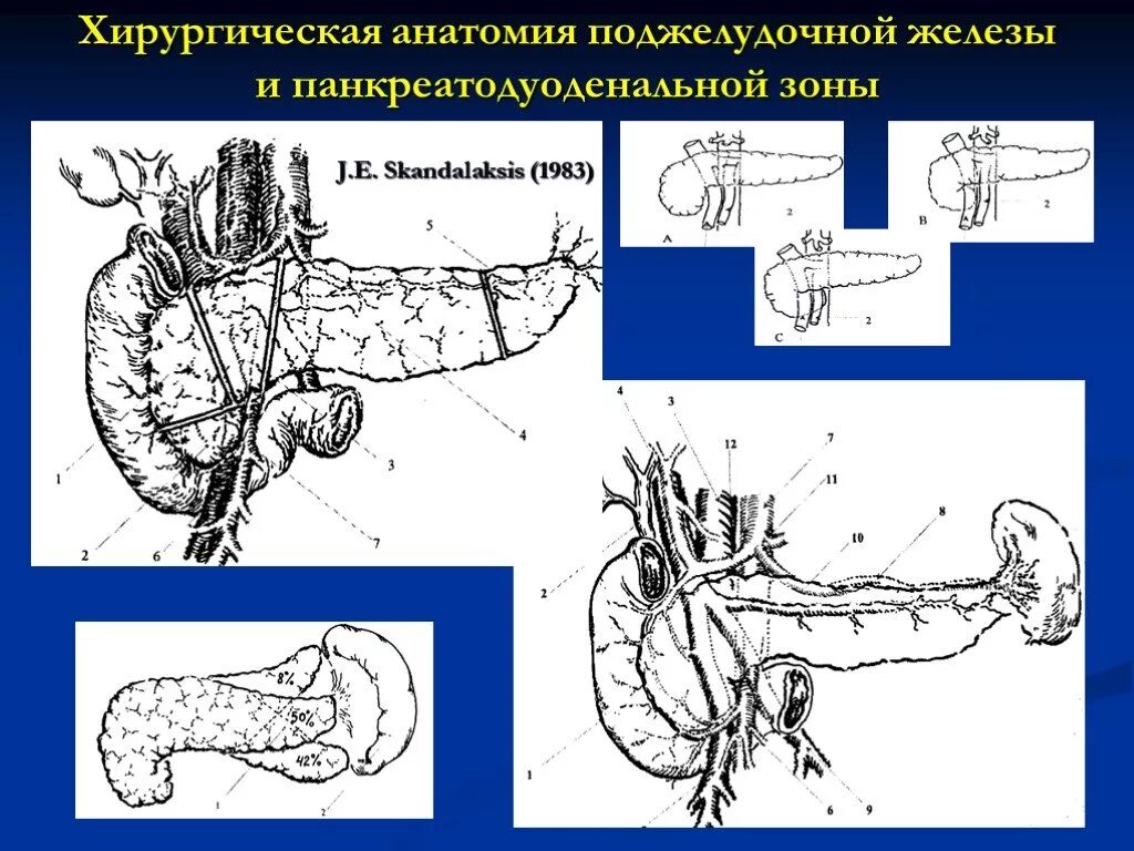 Пдр операция. Панкреатодуоденальная резекция операция Whipple. Опухоли билиопанкреатодуоденальной зоны. Операция Уиппла (панкреатодуоденальная резекция). Панкреатодуоденальные резекции поджелудочной железы.