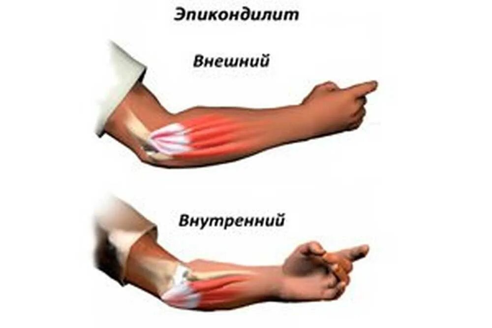 Сколько заживает сухожилие. Симптомы эпикондилита локтевого сустава. Симптомы растяжения мышц руки предплечья. Растяжение мышц локтевого сустава. Патогенез эпикондилит.