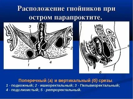Мазь при парапроктите