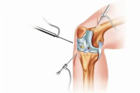Особенности хирургических операций на коленном суставе