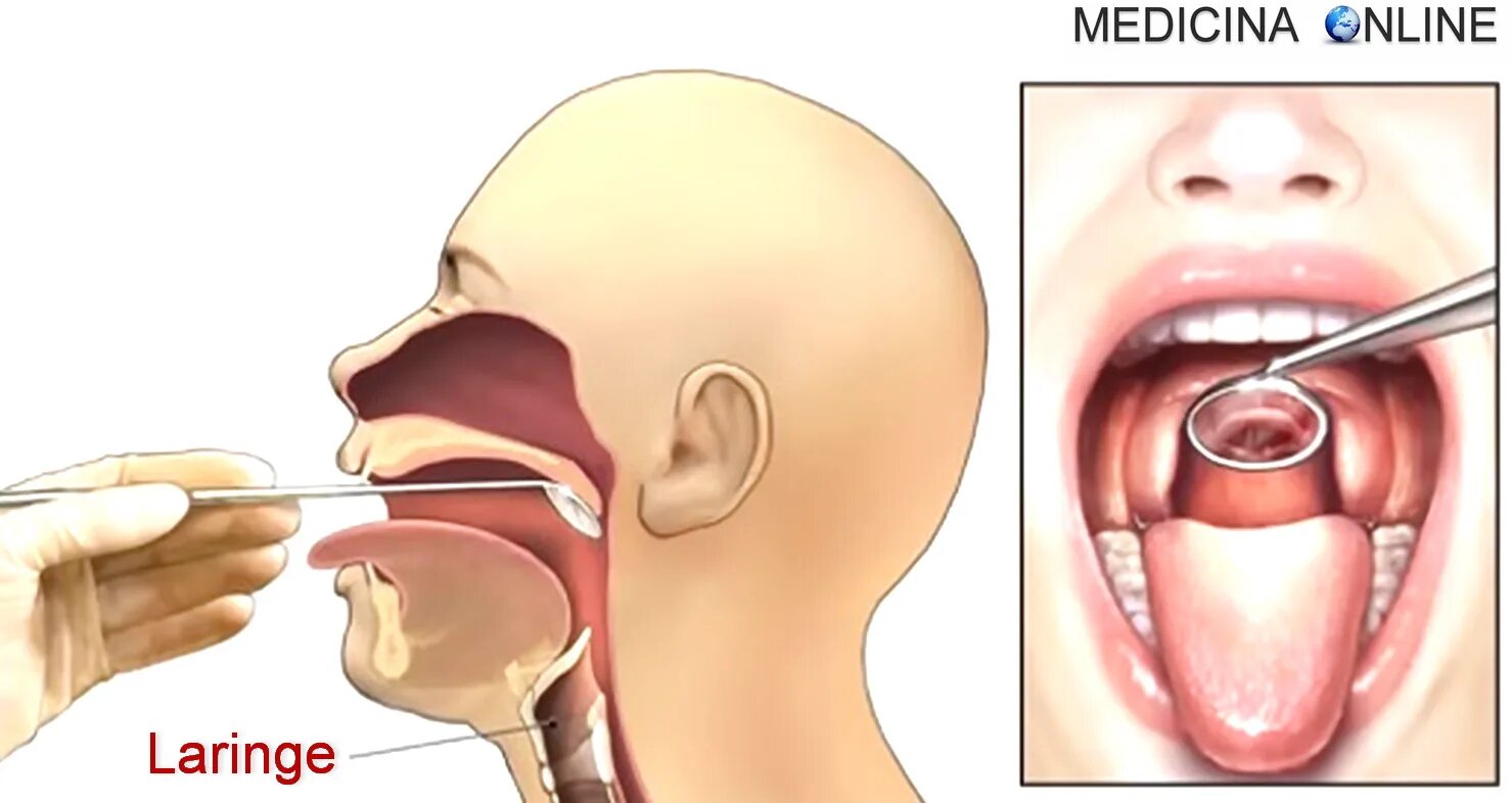 Непрямая ларингоскопия острый ларингит. Ларингоскопия надгортанника. Надгортанник непрямая ларингоскопия. Непрямая ларингоскопия (гипофарингоскопия). Глотка лор