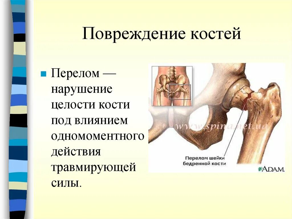 Разрыв кости. Травматические повреждения костей. Перелом повреждение костей.