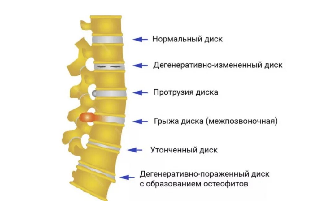 Болит ли протрузия. Протрузия позвонков поясничного отдела. Протрузия межпозвонковых дисков крестцового отдела. Протрузия диска th1/th2. Протрузии диска грудного отдела позвоночника.
