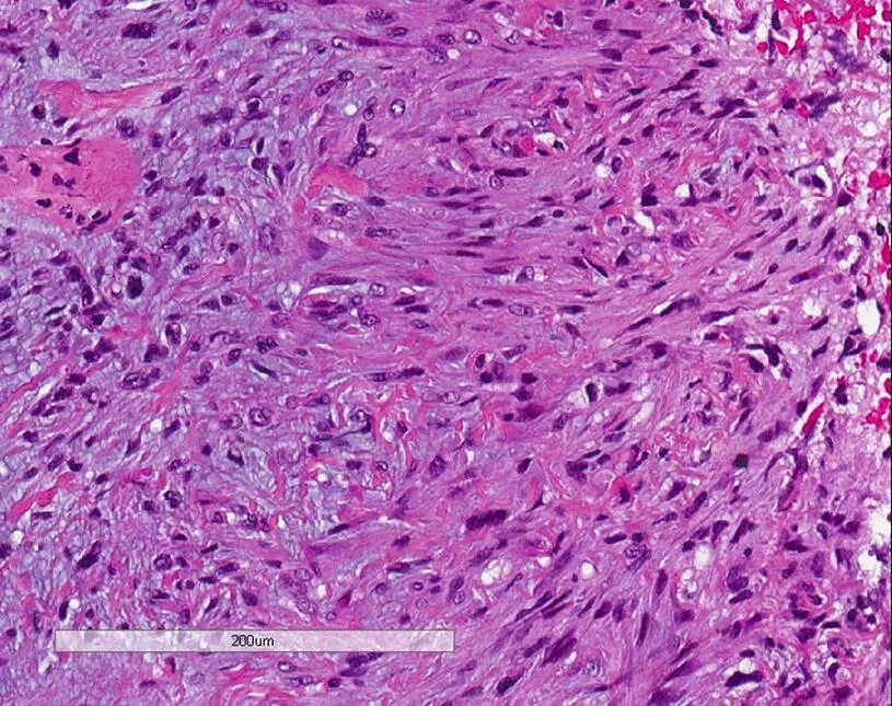 Стромальная саркома. Лейомиосаркома гистология. Эпителиоидная саркома гистология. Рабдомиосаркома гистология. Плеоморфная саркома гистология.