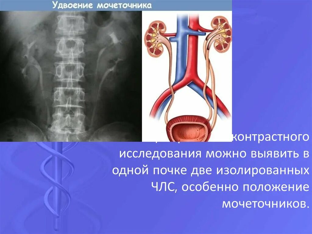 Признаки члс. Неполное удвоение мочеточника. Удвоение чашечно-лоханочной системы почек. Удвоение ЧЛС И мочеточника. Удвоение ЧЛС почки.