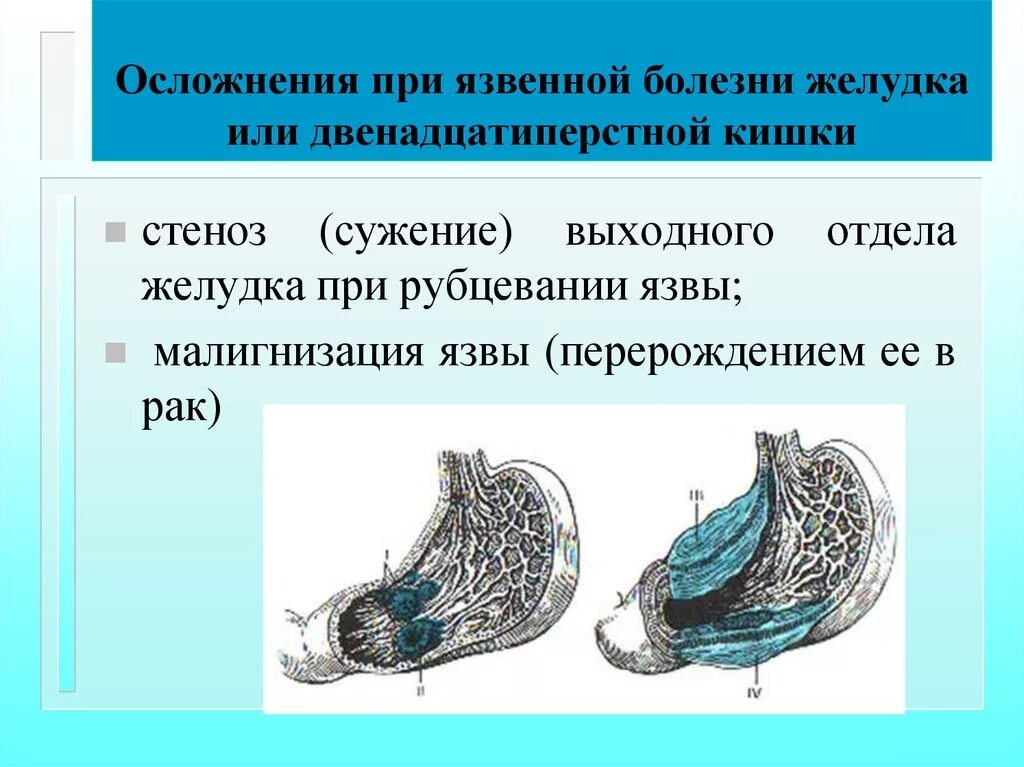 Осложненная язва. Осложнения язвенной болезни желудка и двенадцатиперстной. Осложнения язвенной болезни двенадцатиперстной. Осложнения при язвенной болезни желудка. Осложнения язвенной болезни желудка и двенадцатиперстной кишки.