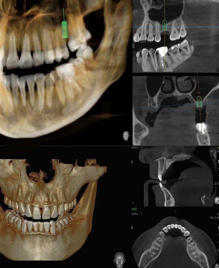 Где сделать кт зуба. Кт зубов VATECH. Кт 17 на 15 VATECH зубов. Компьютерная томография челюстей VATECH.