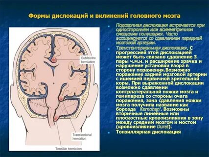 Дислокация головного