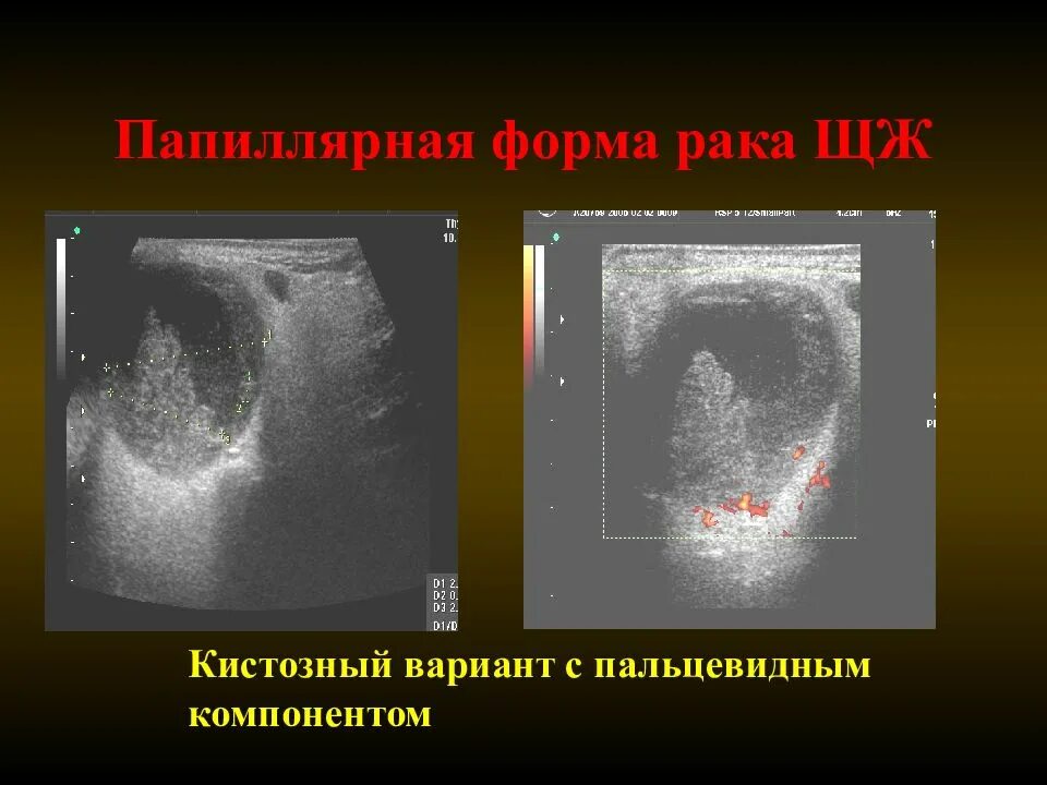 Опухоль щитовидной железы УЗИ. Папиллярная карцинома щитовидной железы УЗИ. Ультразвуковая картина щитовидной железы. Злокачественное образование в ЩЖ. Папиллярный рак после операции