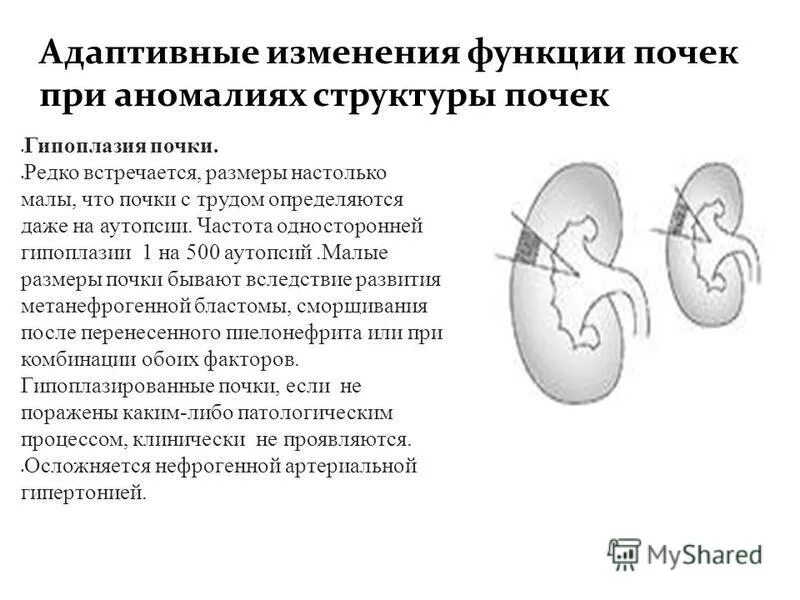 Изменение левой почки. Дифференциальный диагноз гипоплазии почки. Гипоплазия почки дифференциальная диагностика. Признаки гипоплазии почки на УЗИ.