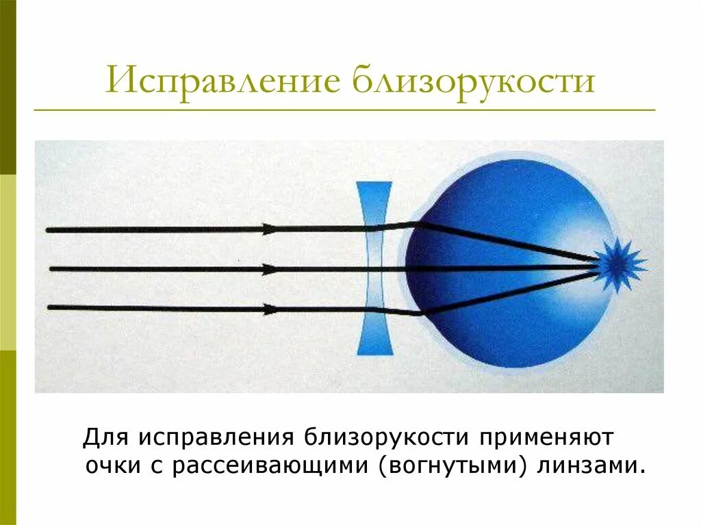 Дальнозоркость линзы двояковыпуклые. Близорукость исправляется рассеивающими линзами. Для исправления близорукости применяют. Коррекция близорукости. Линзы для коррекции миопии (близорукости).