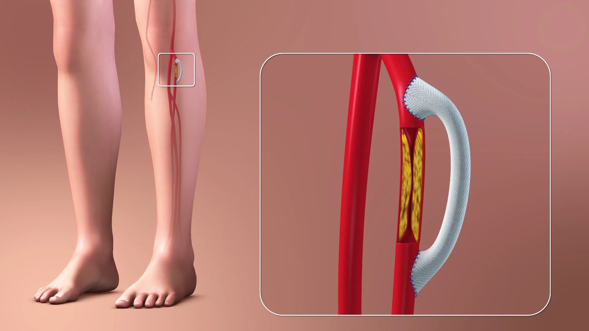 Операция при атеросклерозе сосудов. Шунтирование кровеносных сосудов. Шунтирование артерий конечностей. Шунтирование атеросклероза нижних конечностей. Шунтирование сосудов нижних конечностей.