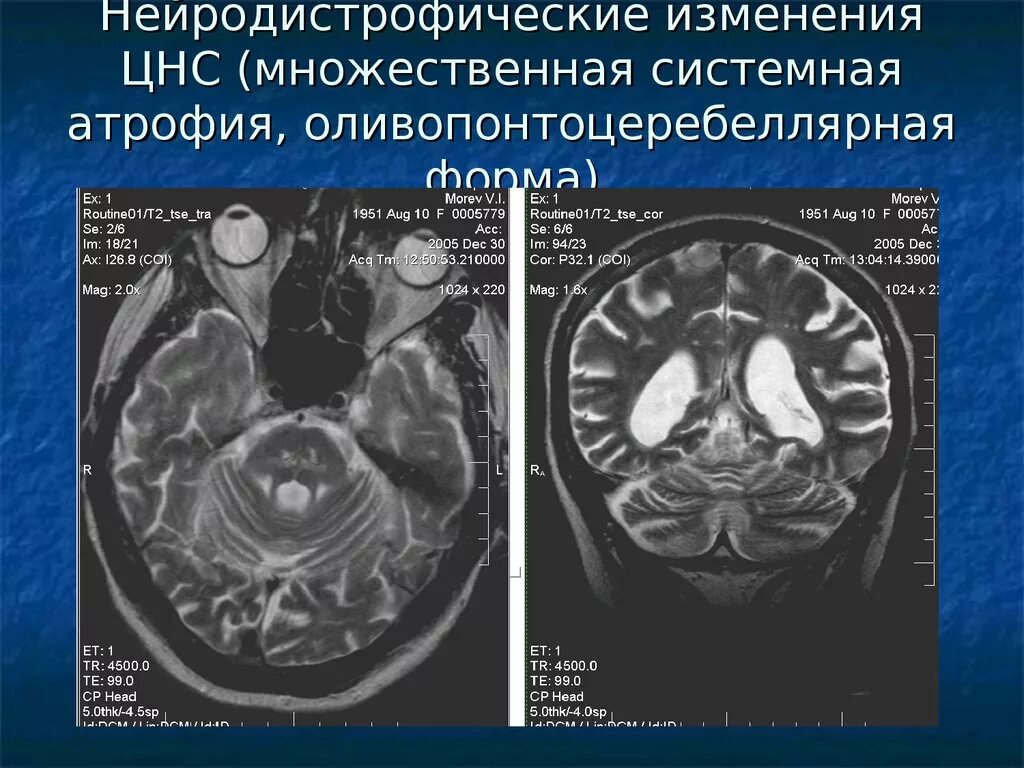 Токсическое поражение мозжечка мрт. Оливопонтоцеребеллярная атрофия. Множественная системная атрофия. Мультисистемная атрофия головного мозга на мрт.