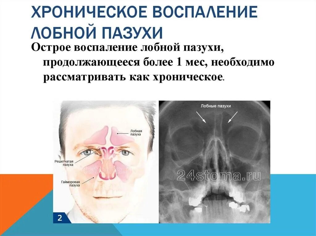 Гайморит признаки. Воспаление основной пазухи сфеноидит. Клиновидная пазуха и сфеноидит. Острый фронтальный синусит симптомы. Сфеноидит -воспаление клиновидной пазухи симптомы.
