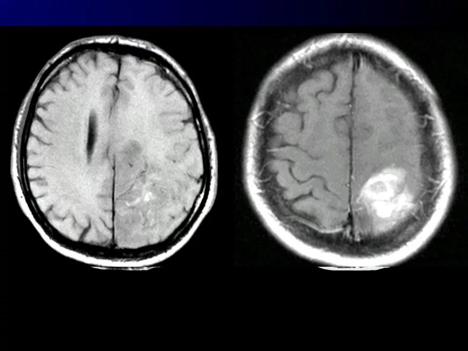Опухоль мозга глиобластома. Глиальная опухоль головного мозга. Олигодендроглиома головного мозга мрт. Глиальная опухоль головного