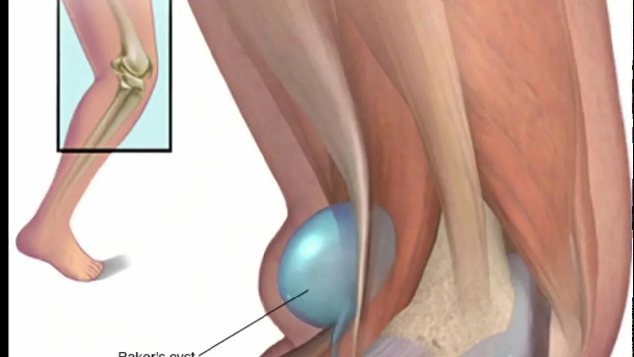 Собирается жидкость в суставах. Подколенная киста Бейкера. Анатомия подколенной ямки. Киста Бейкера. Подколенная грыжа (киста Бейкера.