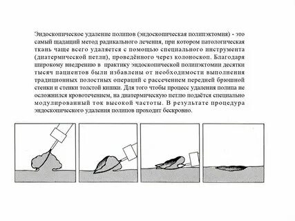 Диета после операции удаление полипов