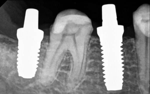 Имплант ankylos. Бредент циркониевые импланты. Металлокерамика и диоксид циркония на импланте. Имплант + коронка штрауман. Зубы имплант цирконий.