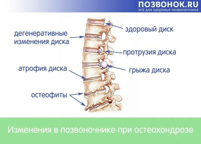 Признаки начальных дегенеративно