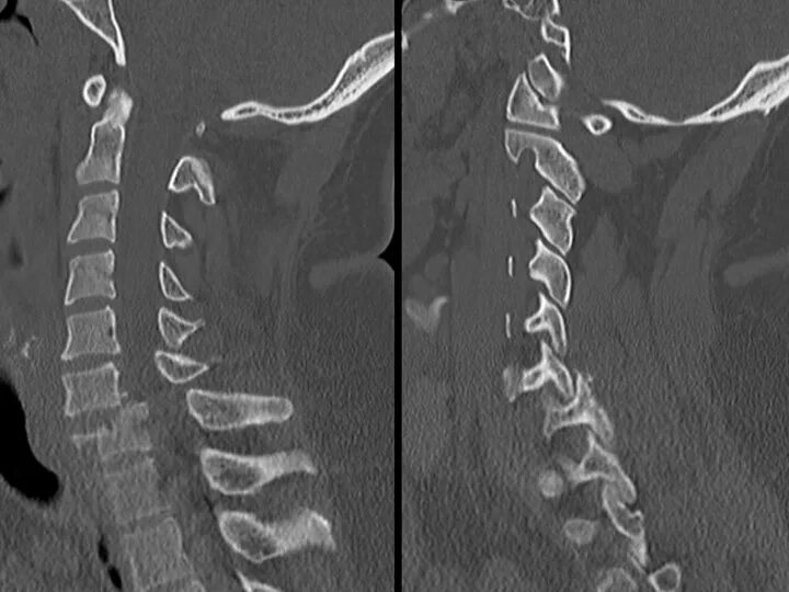 Отдел разрыв. Подвывих с1 шейного позвонка рентген. Подвывих шейного позвонка кт. Подвывих с5 позвонка.. Подвывих поясничного позвонка рентген.