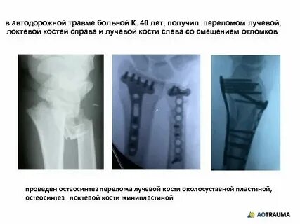 Форум после перелома лучевой