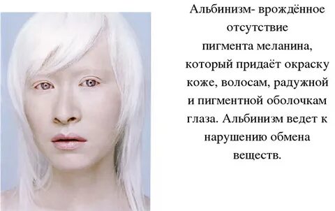 Отсутствие пигмента меланина