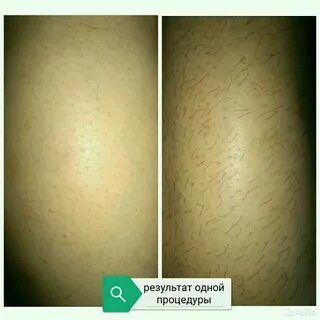 Shr эпиляция