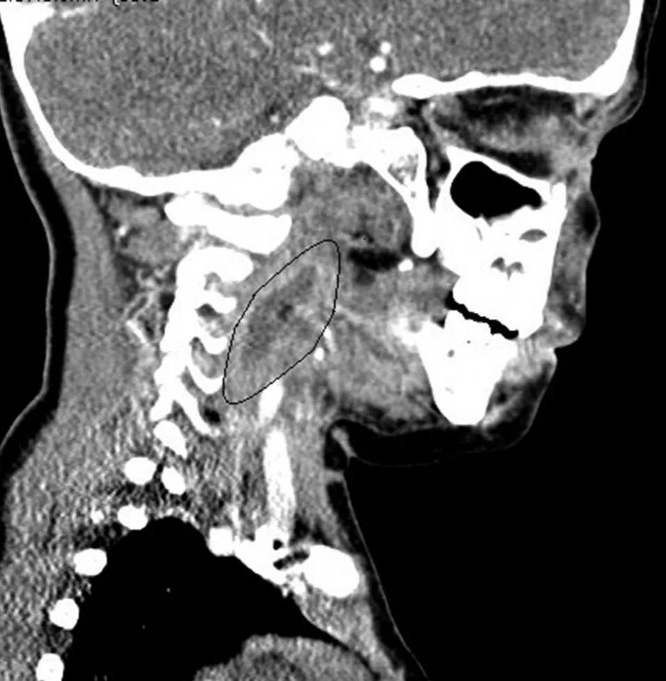 Окологлоточный абсцесс кт. Заглоточный абсцесс кт. Ретрофарингеальный (заглоточный) абсцесс. Ретрофарингеальный абсцесс кт. Кт миндалин