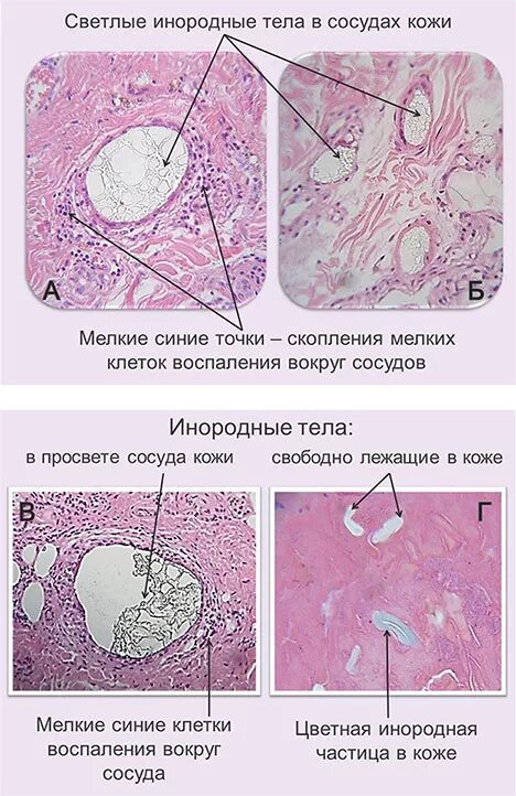 Клетка типа инородных тел. Гранулема инородного тела гистология. гранулема инородного тела микропрепарат описание. воспаление вокруг инородных тел.