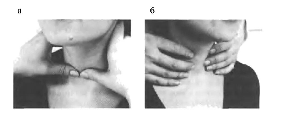 Пальпация щитовидной железы пропедевтика. Техника пальпации щитовидной железы. Техника пальпации щитовидной железы алгоритм. Пальпация щитовидной железы алгоритм пропедевтика. Исследование зоба