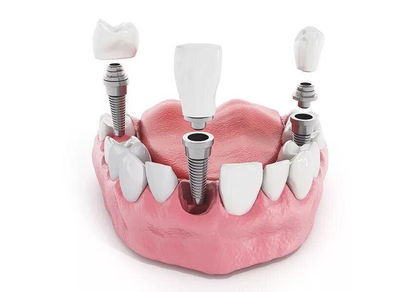 Осстем имплант. Имплантат Straumann стоматология здоровье. Дентальная имплантация. 3 зуба установить