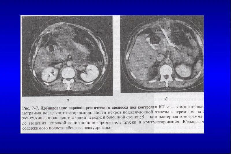 Парапанкреатическая клетчатка что это значит