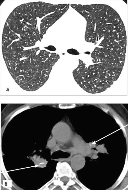 интерстициальный пневмофиброз на кт. саркоидоз легких кт. пневмонит альвеолит кт. бронхиолит на кт. лейкоз поражение легких кт.